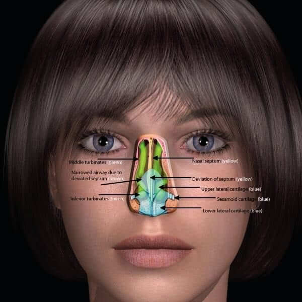 Illustration of a deviated septum from inside the nose