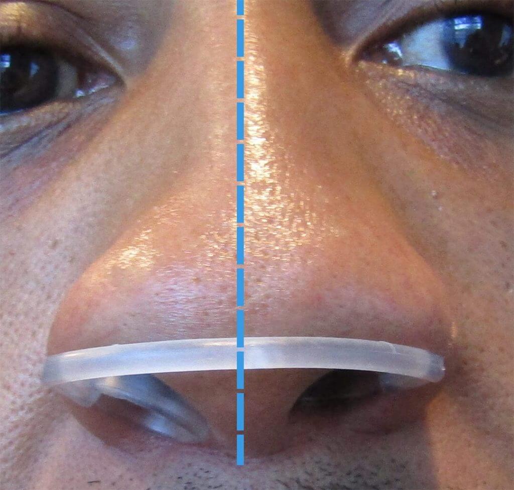 How to Fix a Deviated Septum without Surgery? Find Alternatives. Max