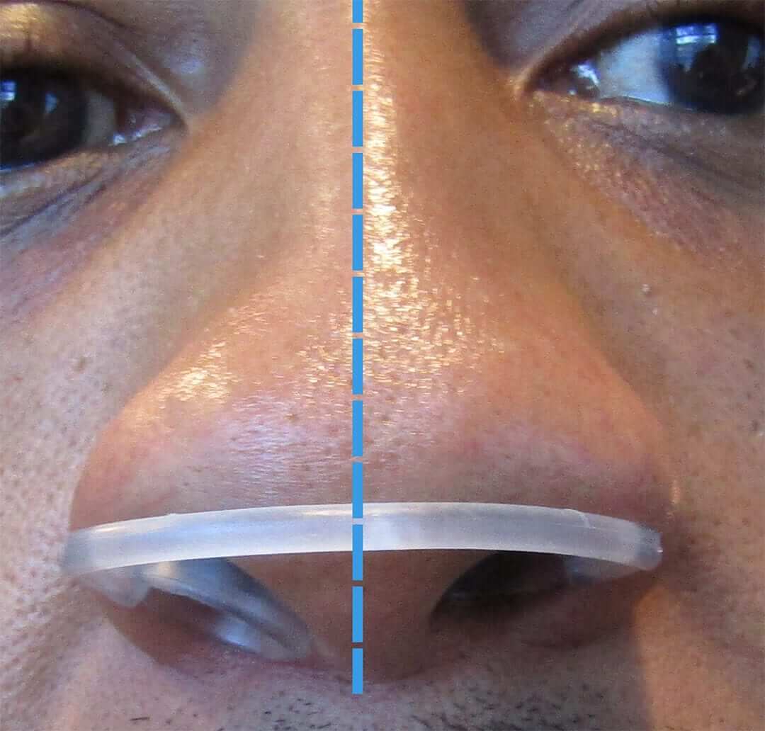 See how Max-Air Nose Cones open the airway around a deviated septum