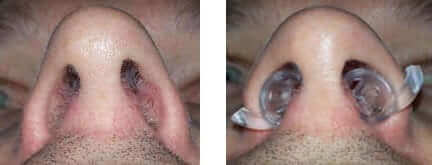 Using Nose Cones to relieve residual nasal obstruction